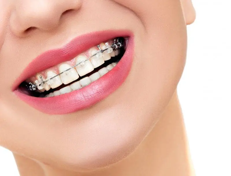Understanding the Cost Breakdown of Braces