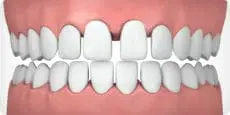 Parker Orthodontics - Gapped teeth - illustrated example