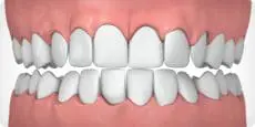 Parker Orthodontics - Over crowded teeth - illustrated example