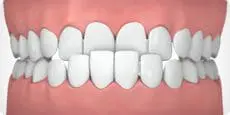 Parker Orthodontics - Underbite - illustrated example
