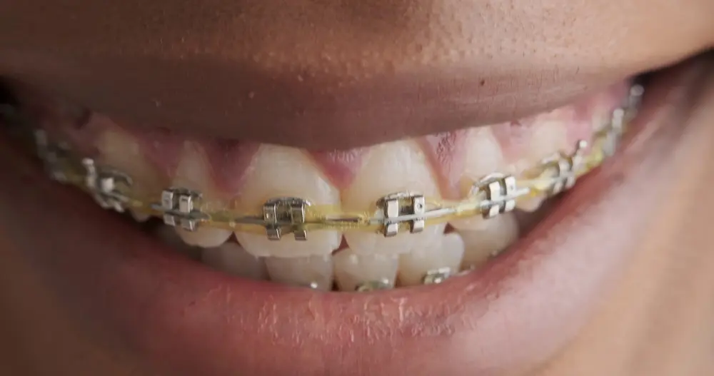 affordable braces