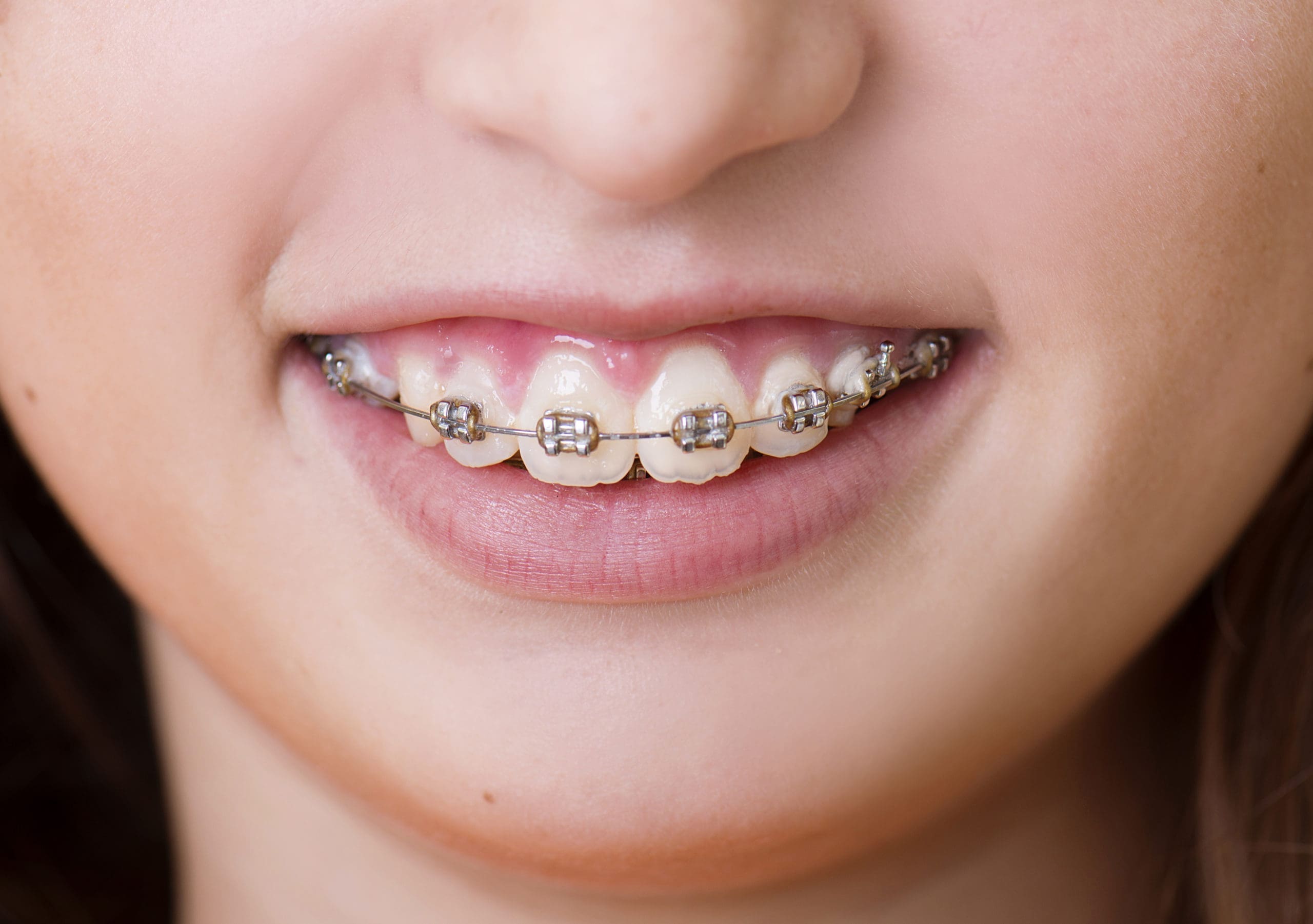 Traditional Braces