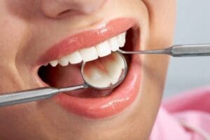 Close-up of patients open mouth during oral checkup with mirror and hook