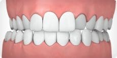 Parker Orthodontics - Crossbite illustrated example