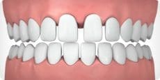 Parker Orthodontics - Gapped teeth - illustrated example