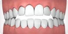 Parker Orthodontics - Underbite- illustrated example