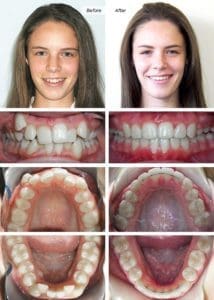 Parker Orthodontics - Patient - Before & After Photos