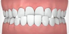 Parker Orthodontics - Underbite - illustrated example