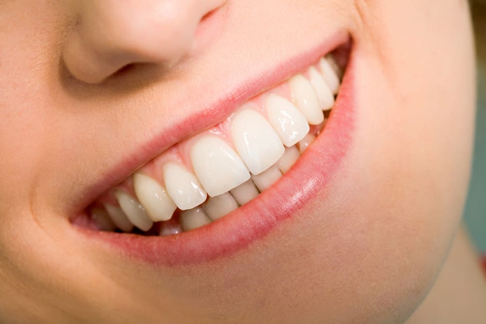 Invisalign Aligners