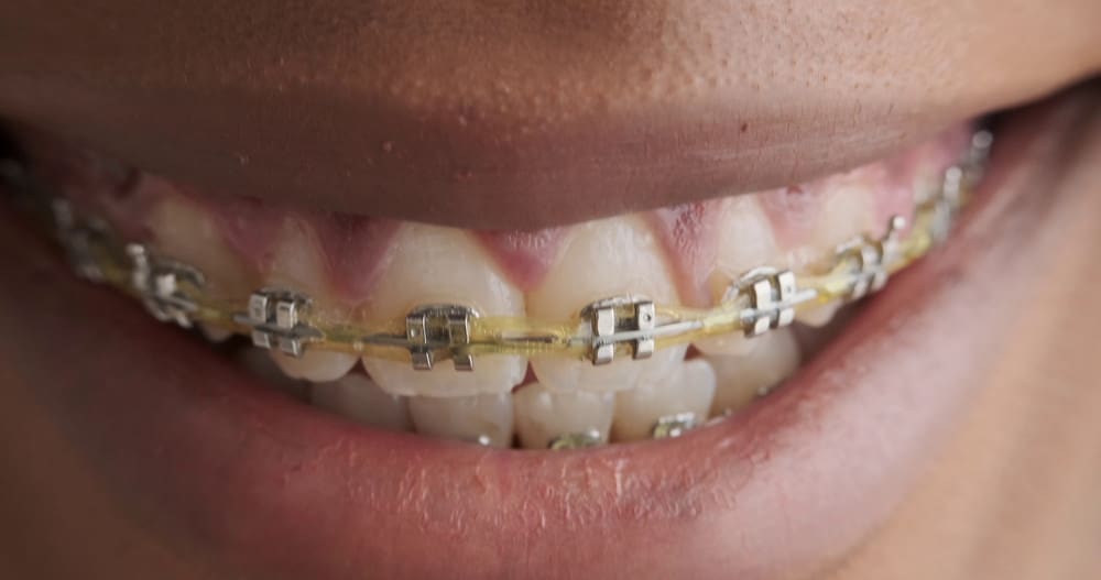 affordable braces