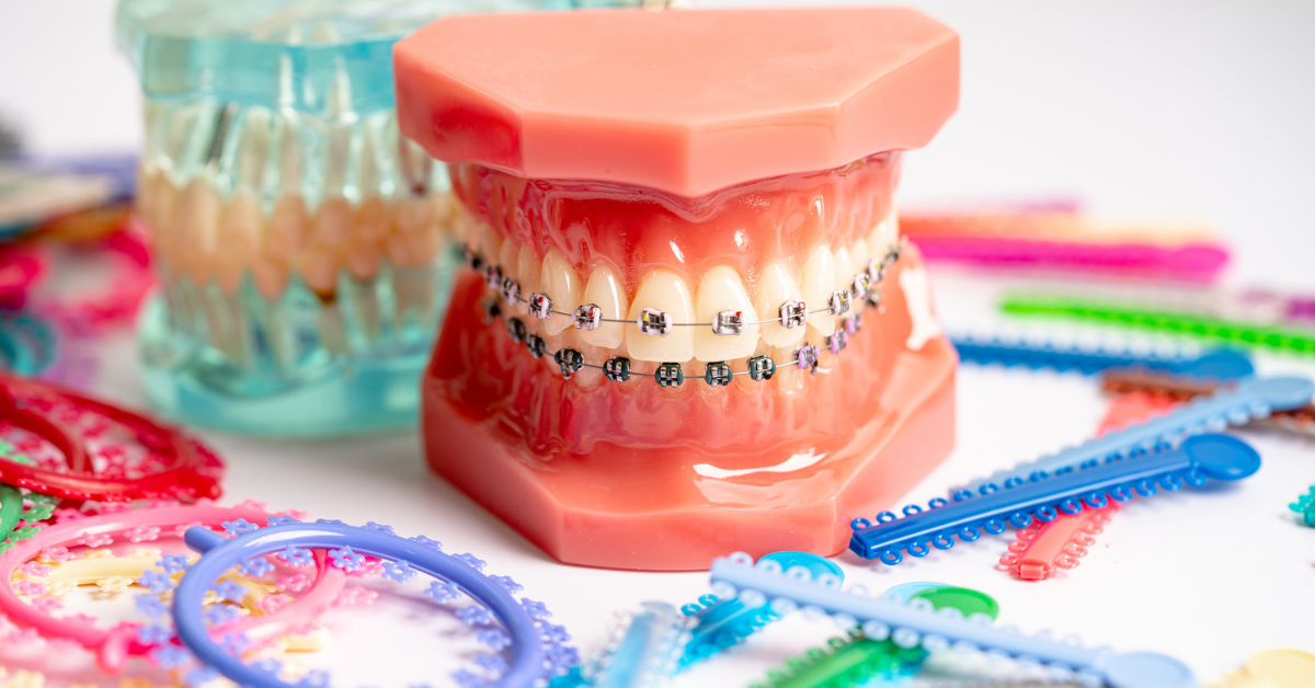 Deep Bite - Causes, Symptoms, and Treatment Options